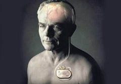 起搏器真的能治好帕金森病嗎？